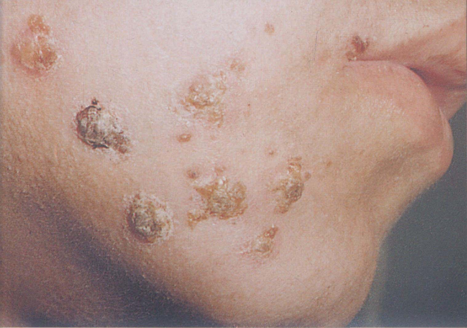「痘痘专题总」一篇文章讲清楚痘痘、痤疮的根源，以及如何治痘、抗痘、预防痘痘 | 红肿痘、脓包痘、囊肿结节 - 知乎